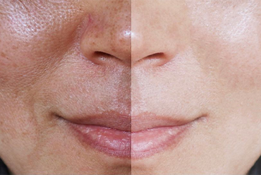 PRX-T33 Skin Rejuvenation Procedure