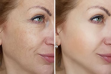 Laser skin resrufacing