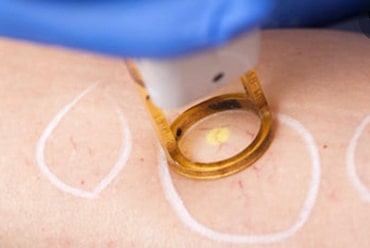 Vascular Lesions Treatment